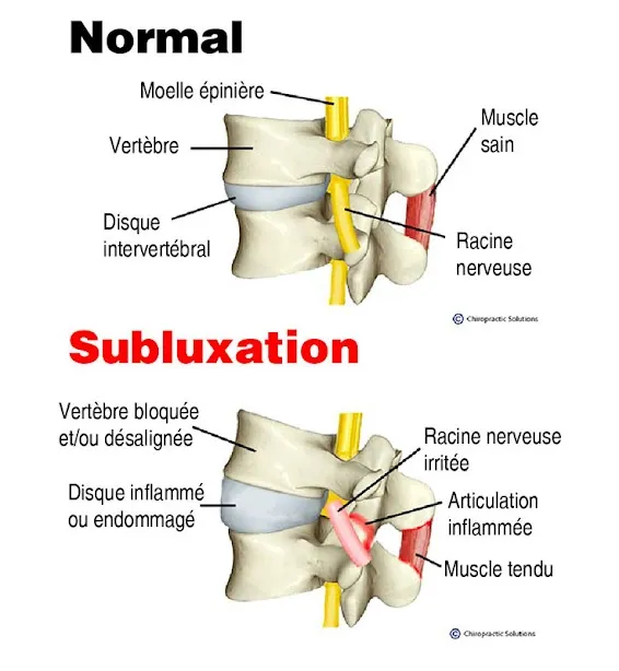 La subluxation vertébrale